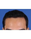 After Hair Transplant &nbsp;Front